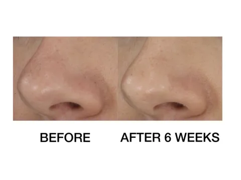 Blackheads Solution Self Heating Extractor 20 ml